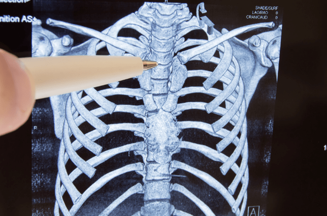 Osteokondroos